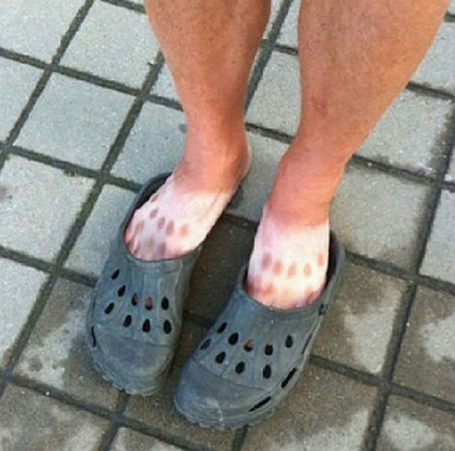 Как не стоит загорать 23 фото